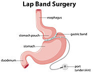 Gastric Band Melbourne | Lap Band Surgery Victoria | Weight Loss Surgeon Melbourne