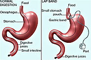 Bariatric Surgery | The Wesley Hospital
