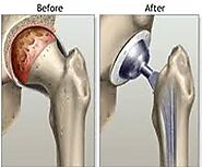 Hip Replacement Randwick, Sydney | Dr Solomon's Recommendation for Hip Replacement