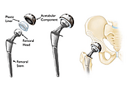 Direct Anterior Hip Replacement Surgery | David Slattery