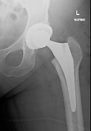 Orthopaedics Victoria : Patient Information - Hip