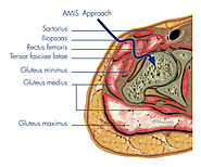 Minimally Invasive Direct Anterior Hip Replacement Surgery | Orthopaedic Surgeon In Wantrina, Melbourne | Knox Orthop...