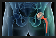 Total Hip Replacement Brisbane | Hip Dislocation Treatment Brisbane