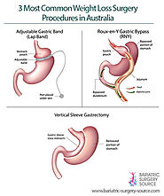 Weight Loss Surgery Australia - All You Need to Know - Bariatric Surgery Source