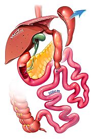 Laparoscopic SADI-S Surgery Sydney - Single anastomosis duodeno–ileal