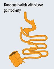 Duodenal Switch. What is it? | New Body Specialists