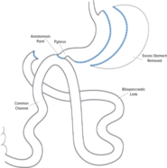 Single Anastomosis Duodenal Switch, WakeMed Health & Hospitals, Raleigh & Wake County, NC