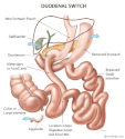 Duodenal Switch - Brisbane Obesity Clinic