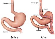 REVISIONAL SURGERY | owlsa