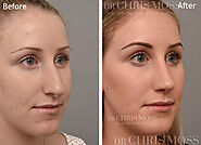 Rhinoplasty Melbourne Nose Jobs by Dr Chris Moss Plastic Surgeon