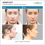Rhinoplasty Nose Reshaping in Melbourne - Coco Ruby Plastic Surgery