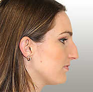 Gold Coast Rhinoplasty | Rhinoplasty (Nose Jobs) Gold Coast - Surgery, Reshaping & Realignment