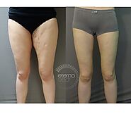 Liposuction Brisbane | Dr Perron Plastic & Cosmetic Surgery
