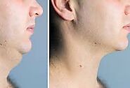 Neck Liposuction in Adelaide • Check Prices & Reviews