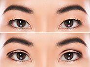 Double Eyelid Surgery Sydney & Campbelltown From $30/Week* - ICCM