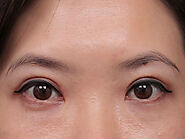 Double Eyelid Surgery Sydney | Asian Eye Lift Surgery Sydney | Shape Clinic