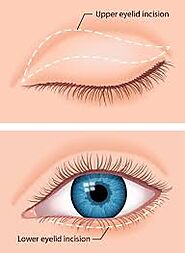 Eyelid Surgery in Sydney • Check Prices & Reviews