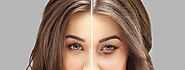 Upper and Lower Eyelid Surgery Melbourne (Blepharoplasty)