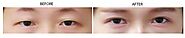 Asian Double Eyelid Surgery Melbourne | Enhance Eye Shape Beautifully Melbourne