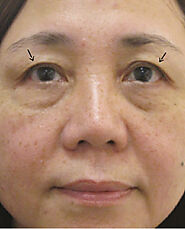 Me Clinic - Double Eyelid Surgery