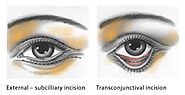 BLEPHAROPLASTY- Eyelid Surgery, Eyelid lift, Eyelid Rejuvenation - Dr Zenia Chow ENT Facial Plastic Surgeon Melbourne