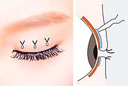 Cosmetic Avenue - Asian Eyelid Surgery | Plastic Surgery Clinic Melbourne