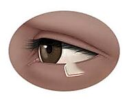 Eyelid Reduction | Dr. David Sharp | Blepharoplasty