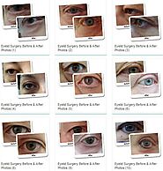 Eyelid Surgery Treatment (Blepharoplasty) By The Expert - Dr Lanzer