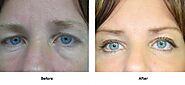 Eyelid Surgery Brisbane Precision Cosmetic Surgery