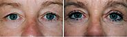 Blepharoplasty - Eyelid Surgery Adelaide | Waverley House