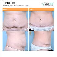 #1 Tummy Tuck Melbourne | Specialist Plastic Surgeons | Coco Ruby