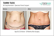 Tummy Tuck - Abdominoplasty Melbourne | Dr Craig Rubinstein