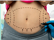 Tummy Tuck Adelaide | What Is Tummy Tuck Surgery?