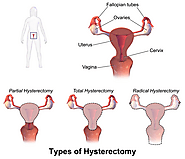 Hysterectomy Surgery Melbourne » Uterus Removal — A/Prof Alex Ades