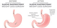 Sleeve and stomach surgery in Querétaro