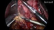 Laparoscopic Biliopancreatic Diversion with Duodenal Switch (BPD/DS) | WebSurg, the online university of IRCAD
