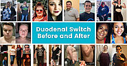 Duodenal Switch Surgery Before and After Photos - Mexico Bariatric Center