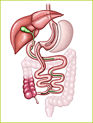Duodenal Switch Mexico: Bariatric Mexico