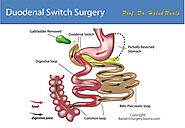 Duodenal Switch (BPD-DS) | Columbia University Department of Surgery