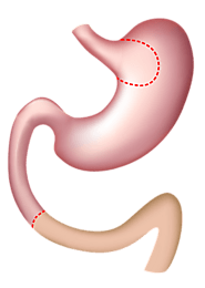 Duodenal Switch Bariatric Surgery