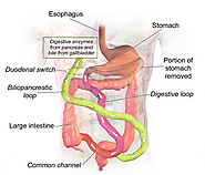 Duodenal Switch Surgery: procedure, recovery, before and after, post-op diet, cost