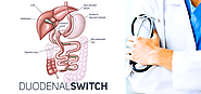 Duodenal Switch Bariatric Surgery