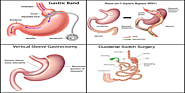 Bariatric Surgery Clinics in Matamoros, Mexico • Check Prices & Reviews