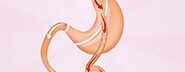 Duodenal Switch Bariatric Surgery