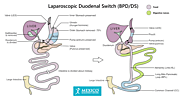 Duodenal Switch Surgery – The Procedure - Mexico Duodenal Switch