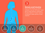 Duodenal Switch (DS) Surgery - 14 Ways It Will Affect You - Bariatric Surgery Source