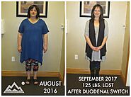 Shelly F.’s Duodenal Switch Story