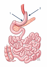 Bariatric weight loss surgery - duodenal switch in Ciudad Juárez