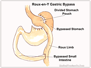 Gastric Bypass in Nuevo Laredo, Mexico | Low-cost, Safe Bariatric Surgery