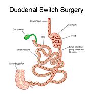 ᑕ❶ᑐ Duodenal Switch Surgery (BPD/DS) in Tijuana, Mexico